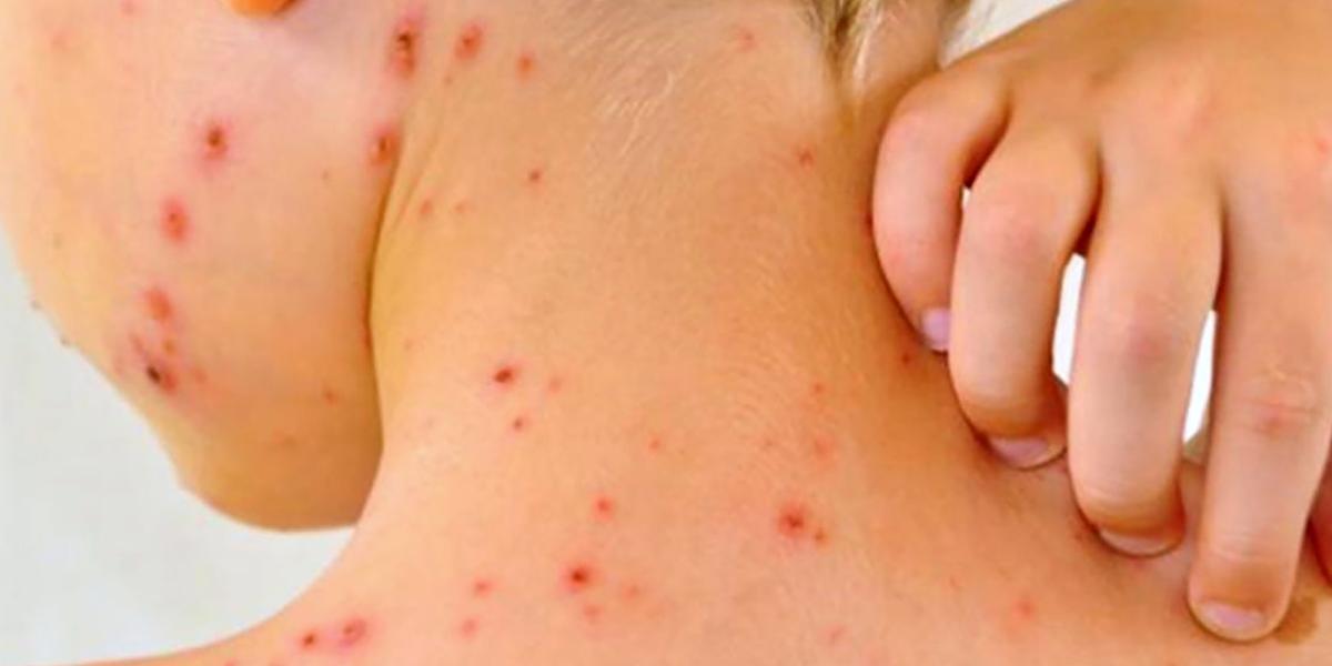 La OPS detalló que de las 28 muertes por sarampión en la región de América, 23 de ellas han ocurrido en México